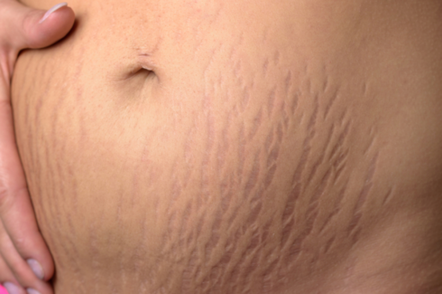 Is coconut oil the best for stretch marks? Know what 99% people say