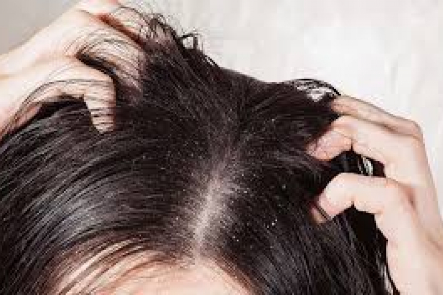 Many people suffer from dandruff during the season change. Using thousands of products available in the market does not help.