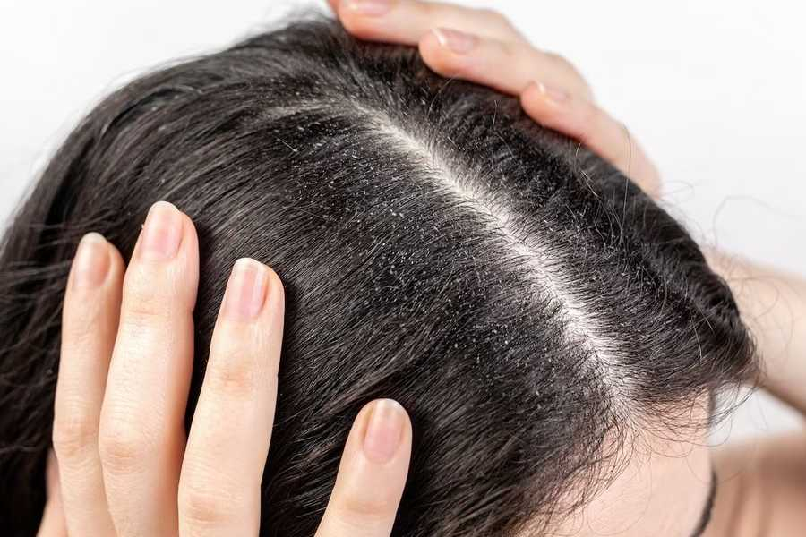 Hair dandruff