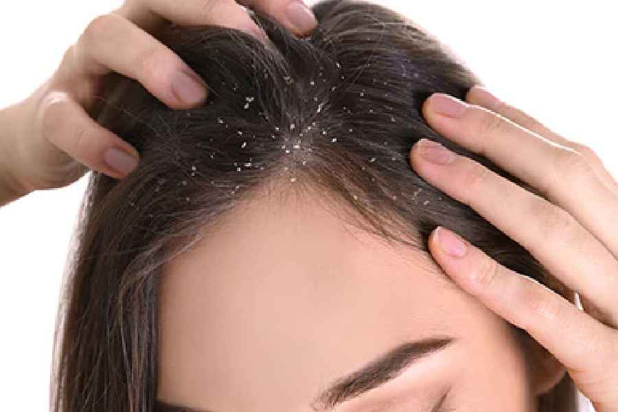 Many people suffer from dandruff during winter. Using thousands of shampoos and medicines available in the market does not help.