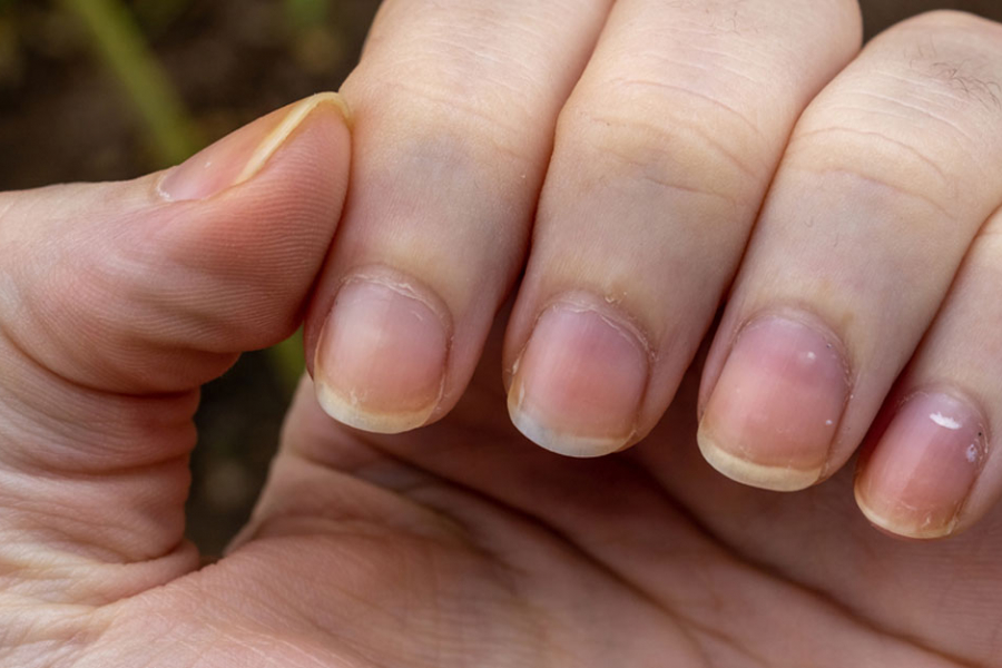 Yellow spots on nails are a very common problem due to prolonged work pressure
